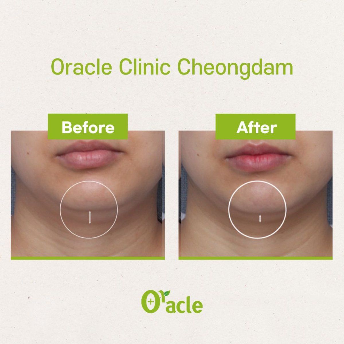 Ultherapy before and after results at Oracle Clinic Cheongdam, visible jawline tightening