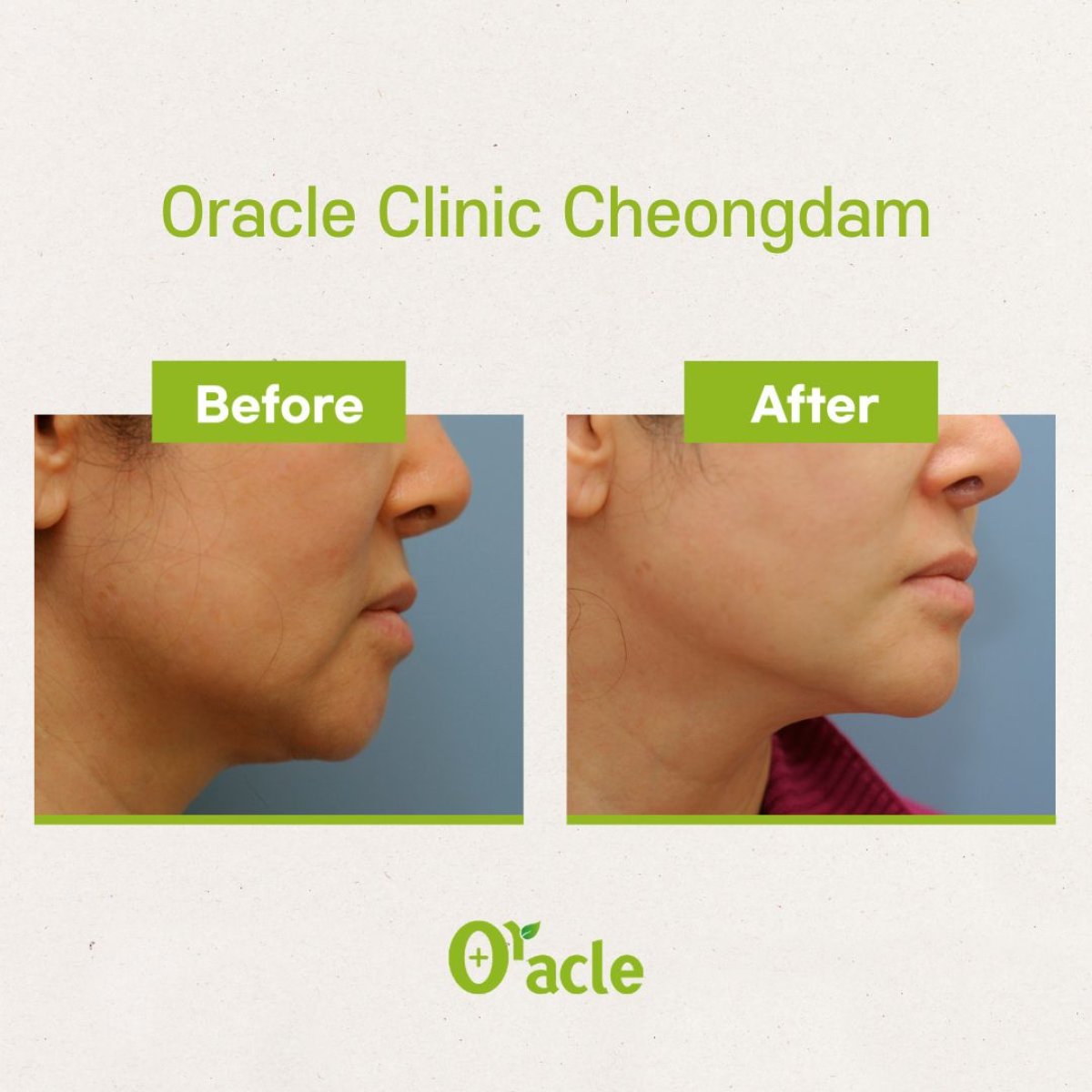Resultados de Ultherapy antes y después en Oracle Clinic Cheongdam, piel facial más firme