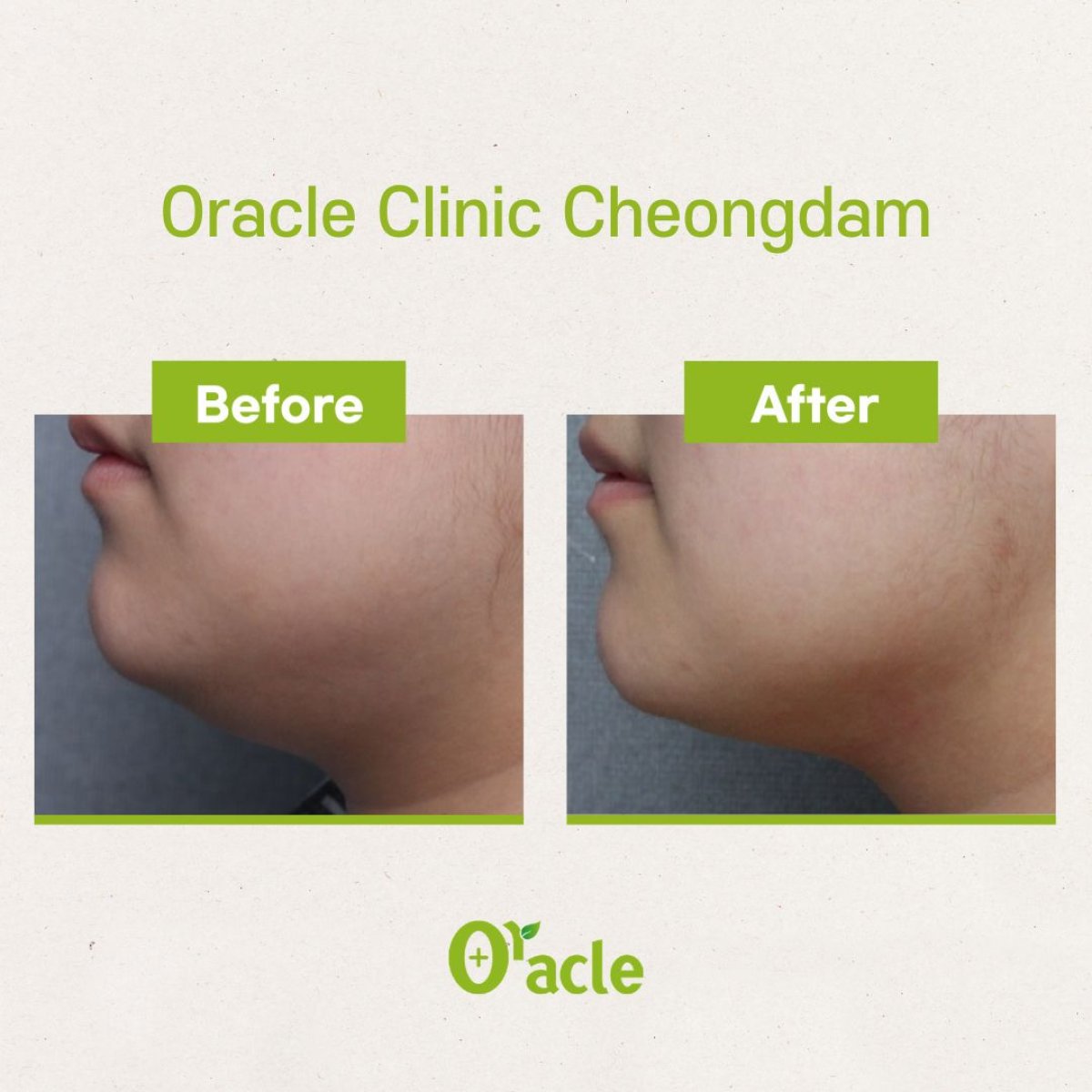 Результаты до и после ультерапии в Oracle Clinic Cheongdam, подтяжка линии подбородка