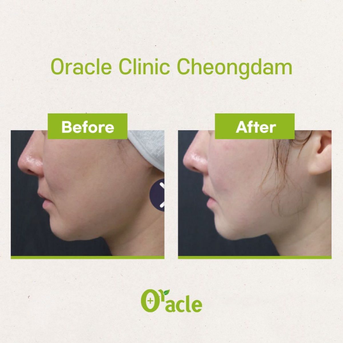 Before and after Ultherapy results at Oracle Clinic Cheongdam, visible facial skin tightening