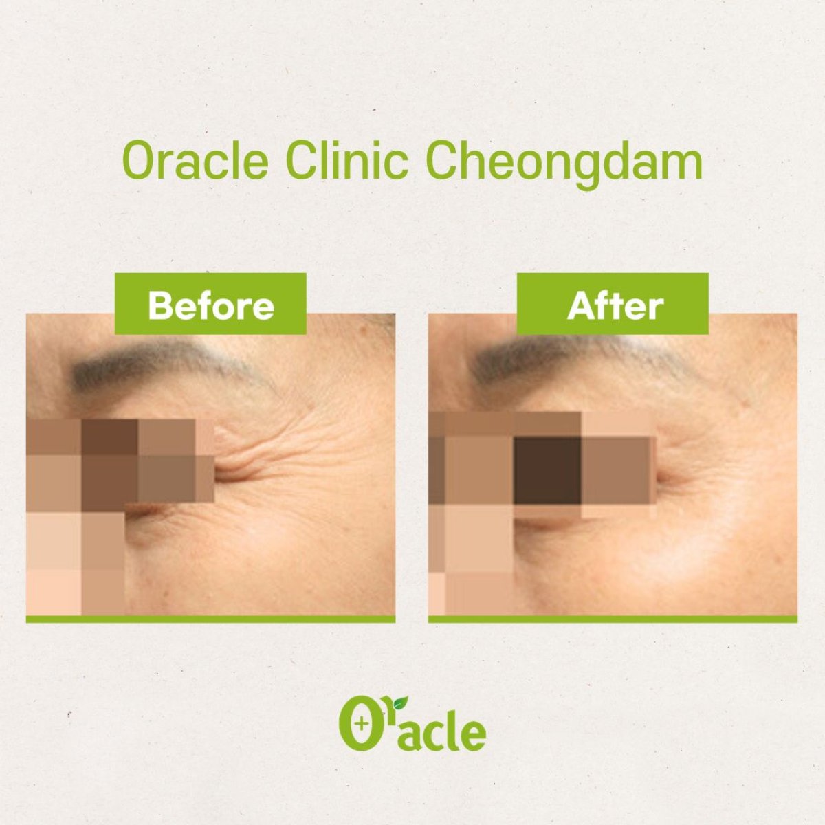 Thermage eye wrinkle reduction before and after results at Oracle Clinic Cheongdam