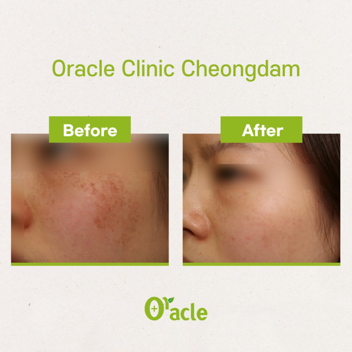 Thermage before and after results at Oracle Clinic Cheongdam, improved facial skin texture