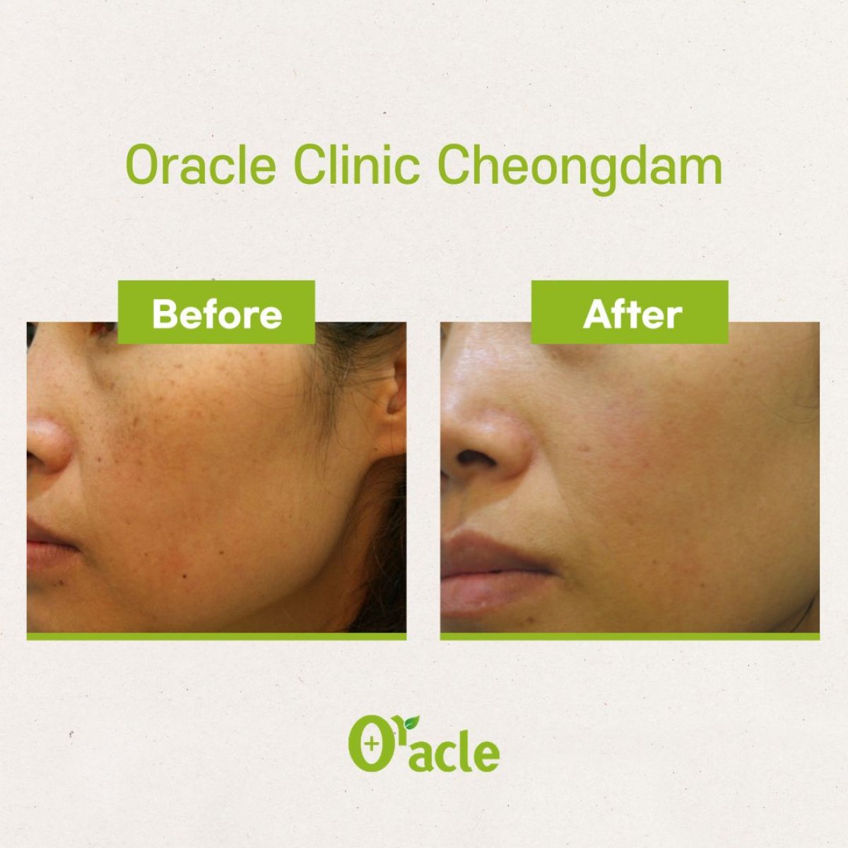 نتائج علاج البشرة IPL قبل وبعد في Oracle Clinic Cheongdam، تحسين لون البشرة