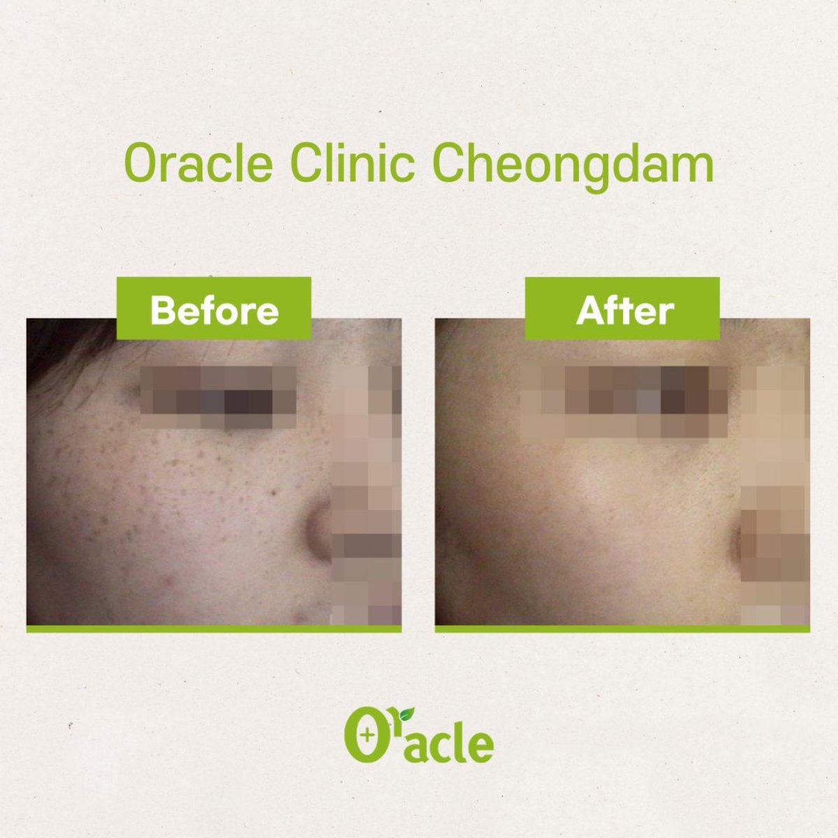 نتائج علاج البشرة IPL قبل وبعد في Oracle Clinic Cheongdam، تحسين لون البشرة
