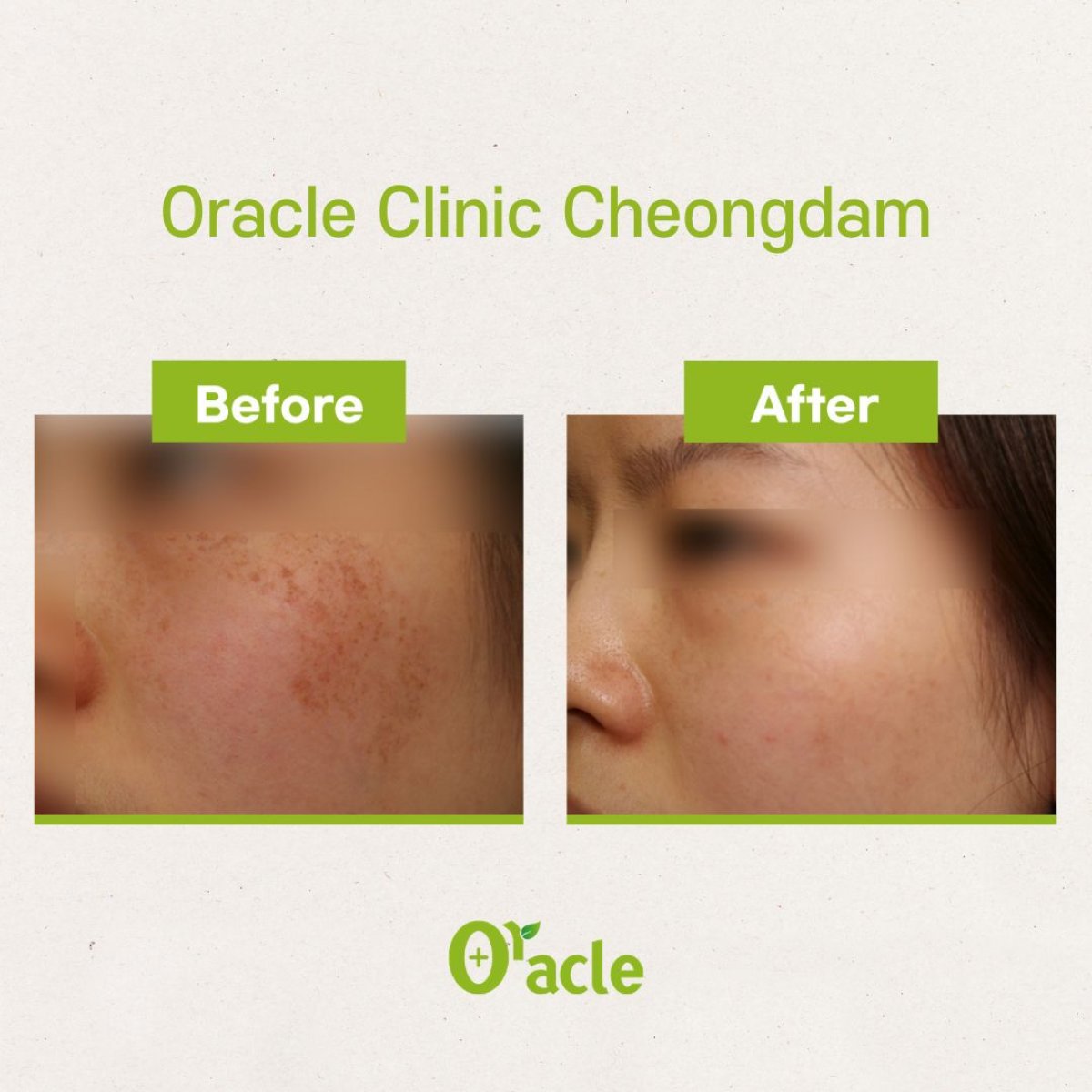نتائج علاج البشرة IPL قبل وبعد في Oracle Clinic Cheongdam، تحسين لون البشرة