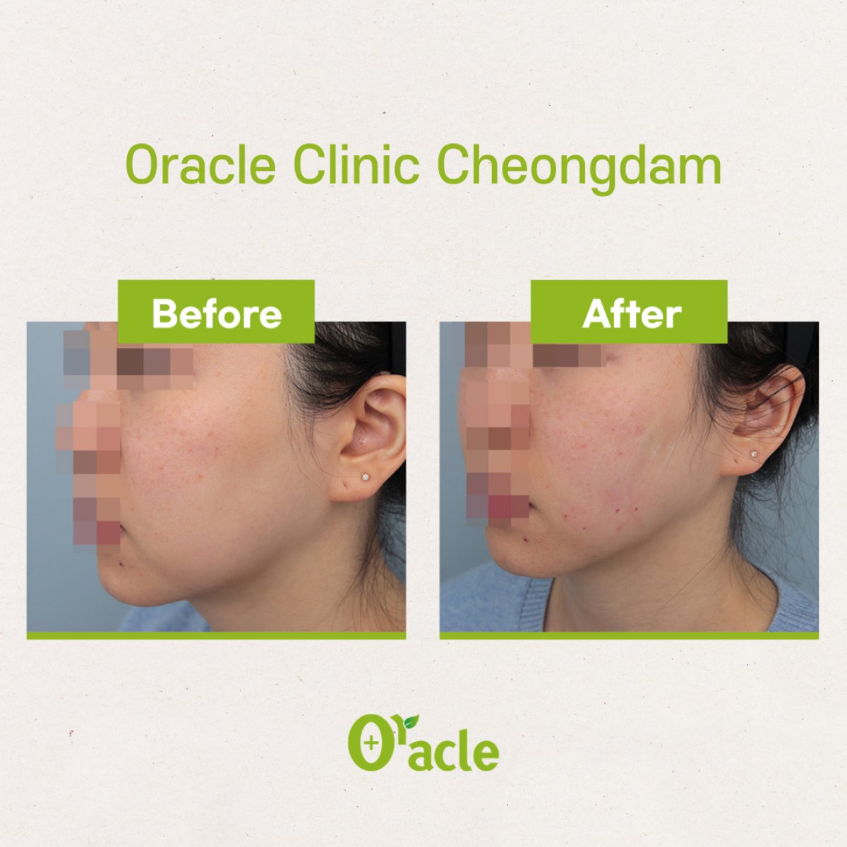 Before and after thread lifting results at Oracle Clinic Cheongdam, visible facial contour lift