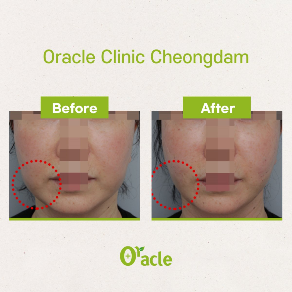 Результат до и после нитевого лифтинга в Oracle Clinic Cheongdam, улучшение контура лица