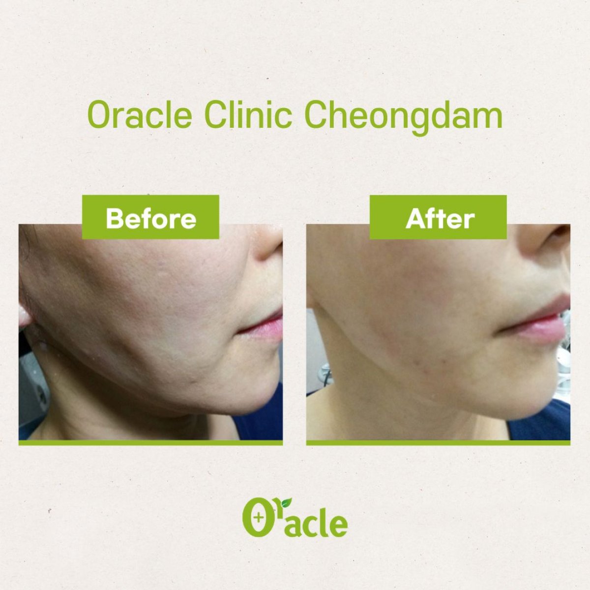 Результаты до и после нитевого лифтинга в Oracle Clinic Cheongdam, улучшение контура лица