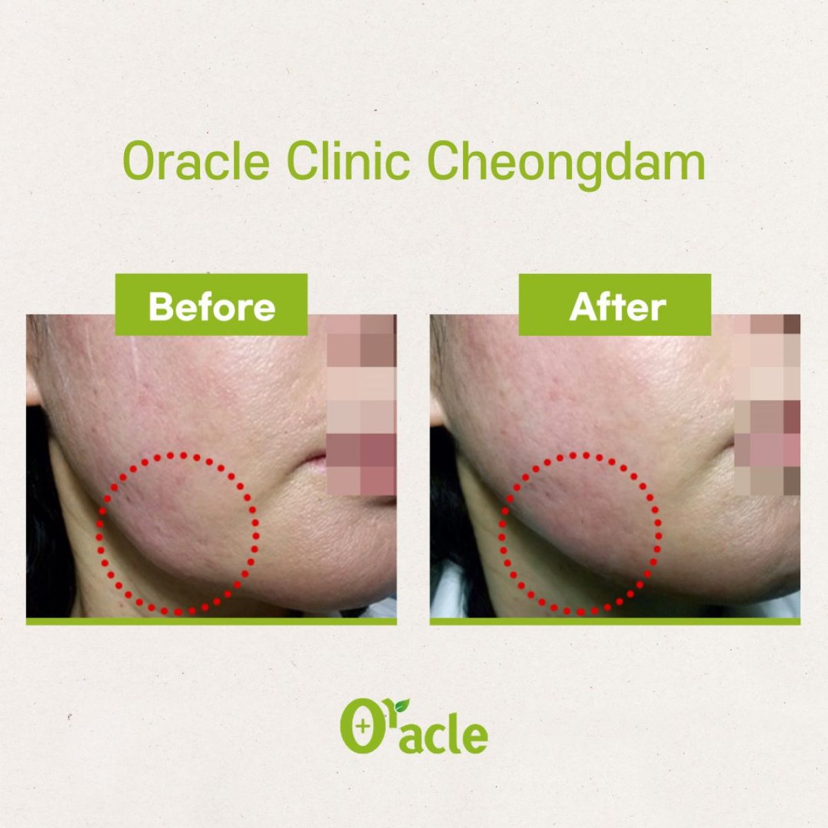 نتائج شد الوجه بالخيوط قبل وبعد في Oracle Clinic Cheongdam، تحسين تحديد الفك
