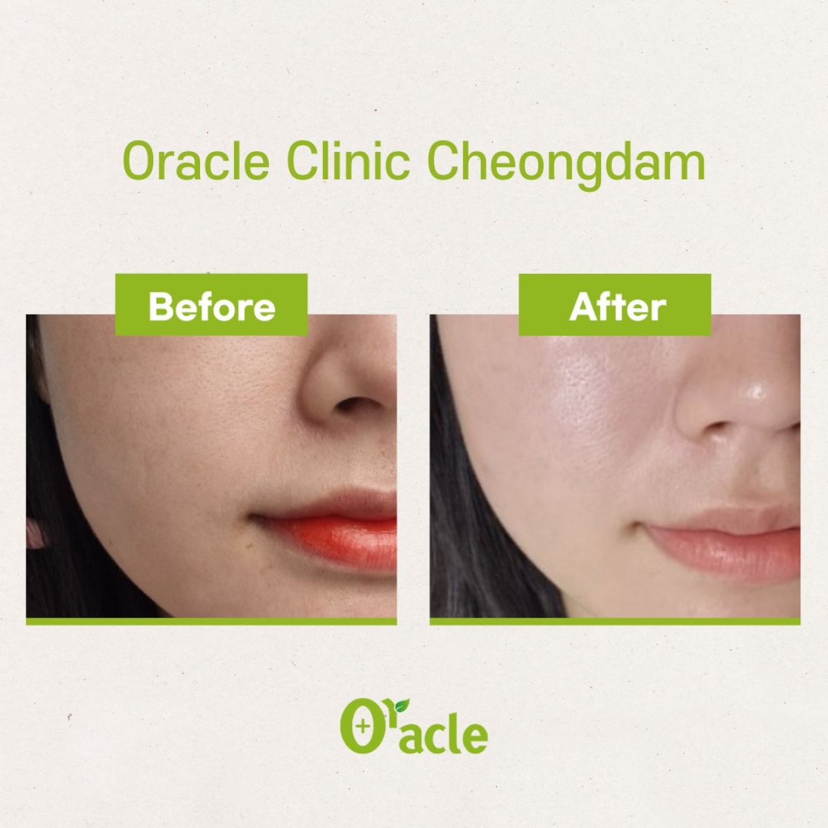 Результат до и после нитевого лифтинга в Oracle Clinic Cheongdam, улучшение контура лица