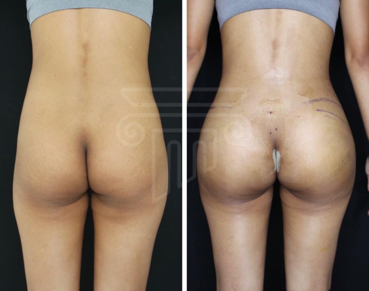 Antes y después de implantes de glúteos en Dr. Safa Manav Clinic – contorno mejorado