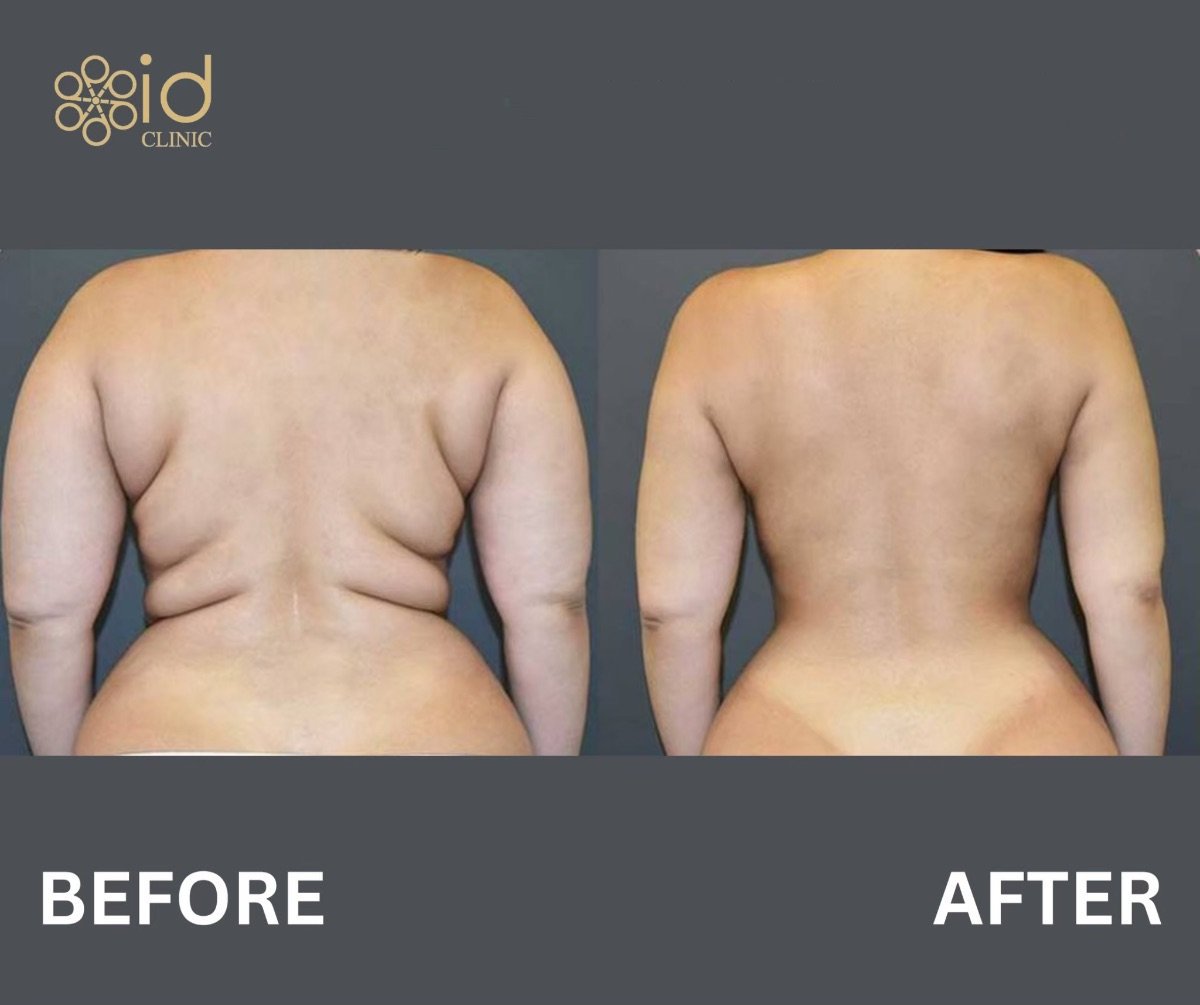 Résultats avant et après back lift à ID Clinic Bangkok, contour du dos amélioré