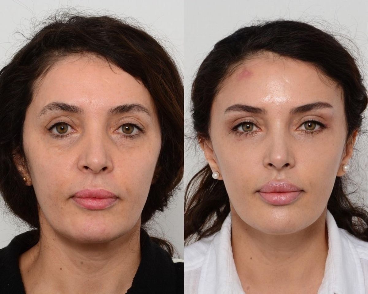 Facelift before and after results at Memorial Şişli Hospital, visible facial rejuvenation