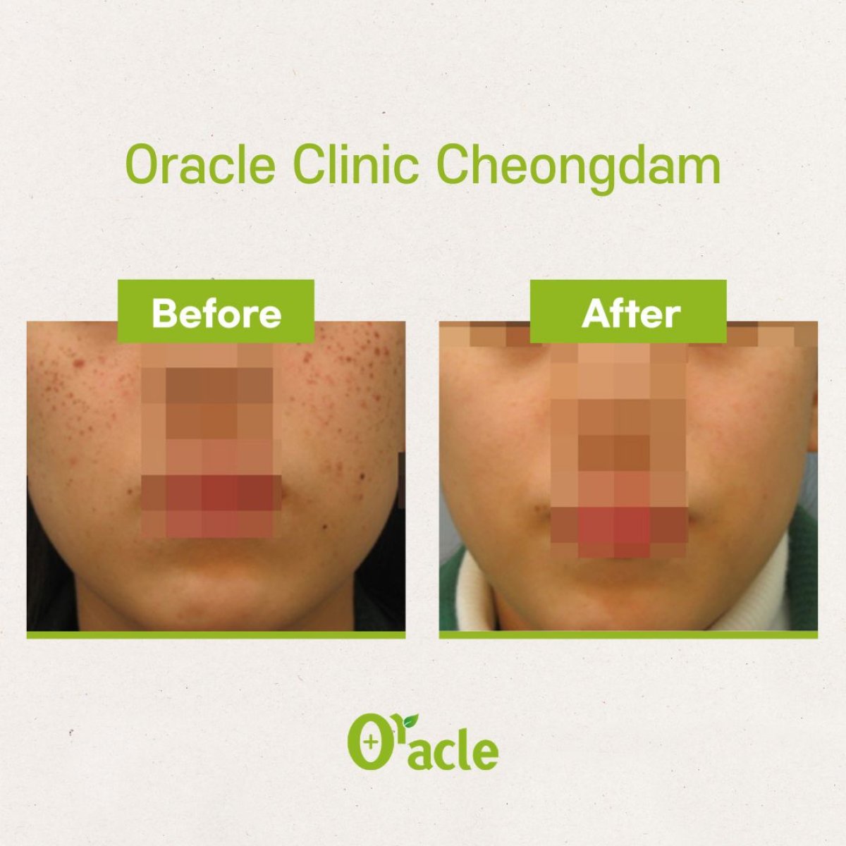 نتائج علاج البشرة IPL قبل وبعد في Oracle Clinic Cheongdam، وضوح بشرة محسّن