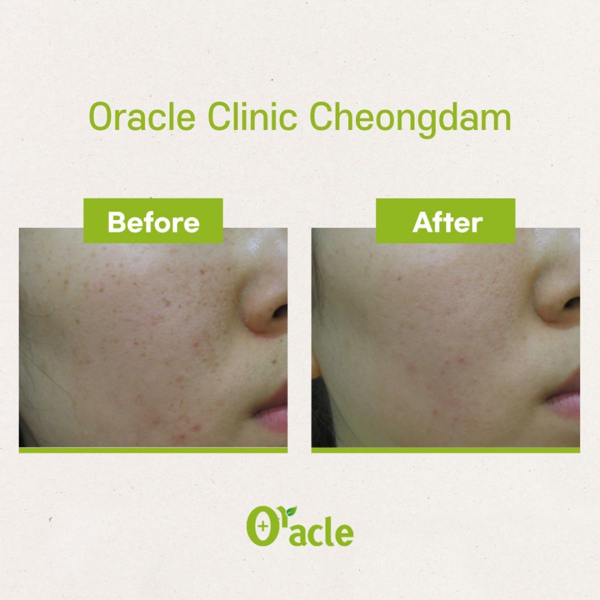نتائج علاج البشرة IPL قبل وبعد في Oracle Clinic Cheongdam، وضوح بشرة محسّن