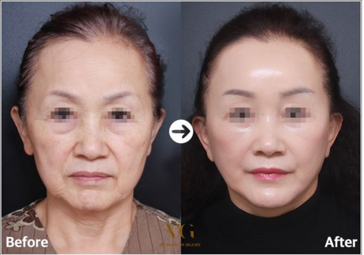 نتائج شد الوجه غير الجراحي قبل وبعد في VG Plastic Surgery، تجديد شباب الوجه واضح