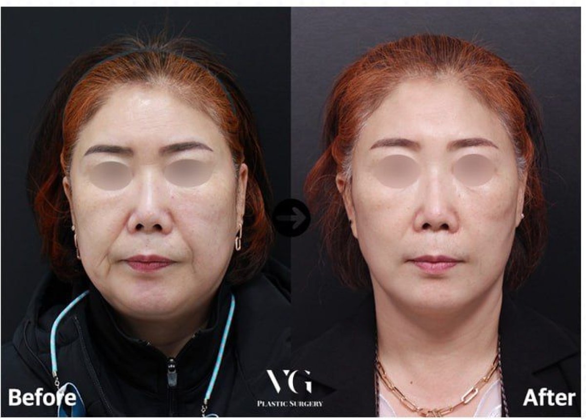 Результат до и после безоперационной подтяжки лица в VG Plastic Surgery – омоложение лица