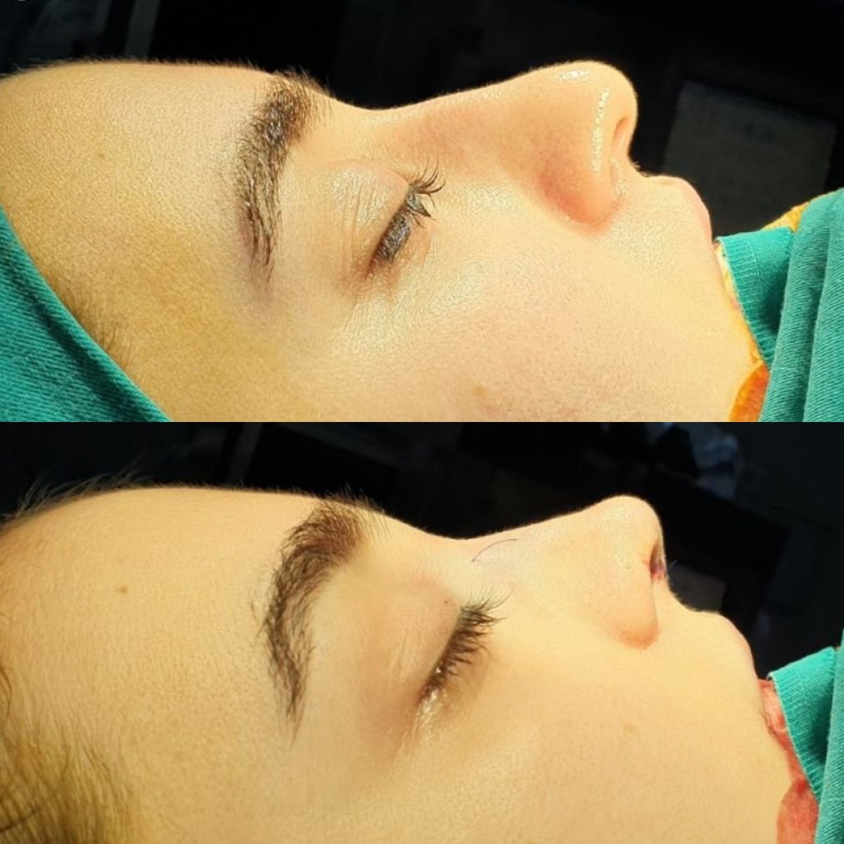 نتائج عملية تجميل الأنف قبل وبعد في عيادة Dr. Safa Manav، تحسين شكل الأنف