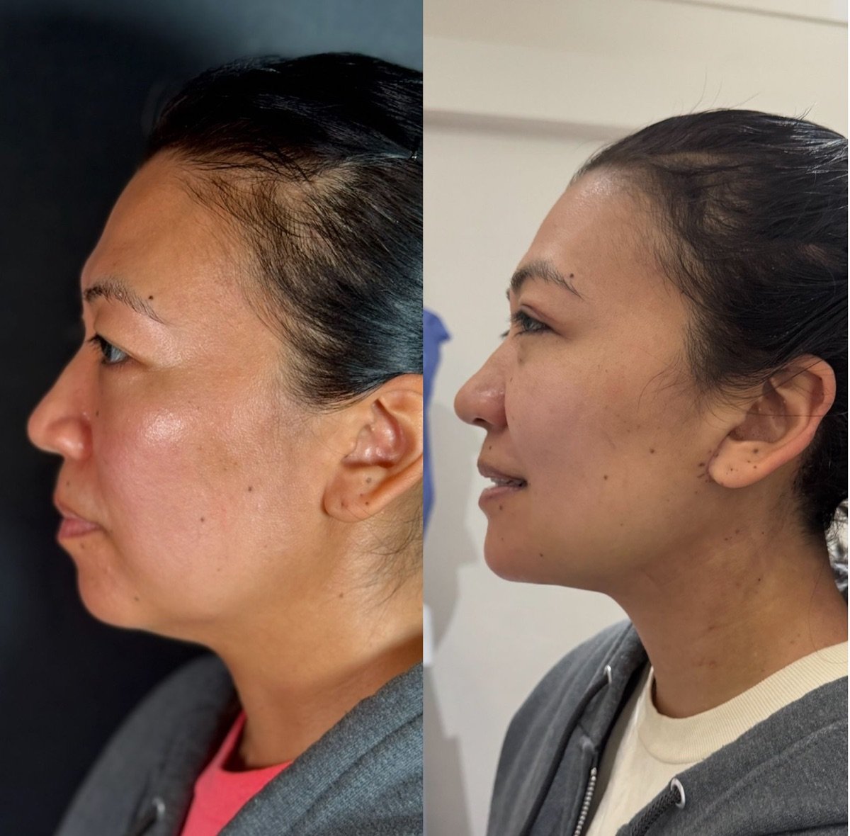 نتائج شد الرقبة قبل وبعد في Marroquín & Sandoval Plastic Surgery Clinic، تحسين تحديد الرقبة
