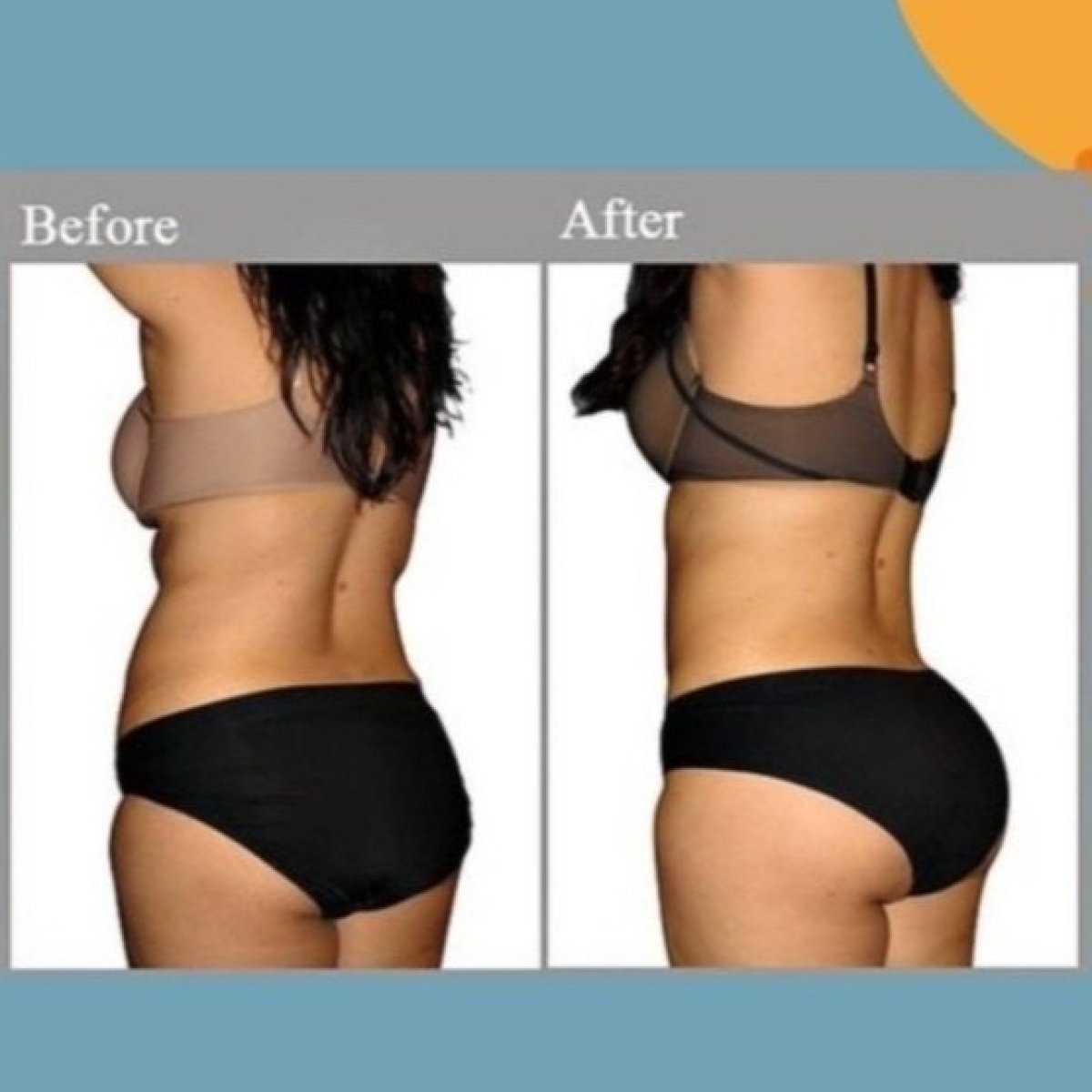 Before and after Brazilian Butt Lift results at ID Clinic Bangkok, enhanced buttock contour