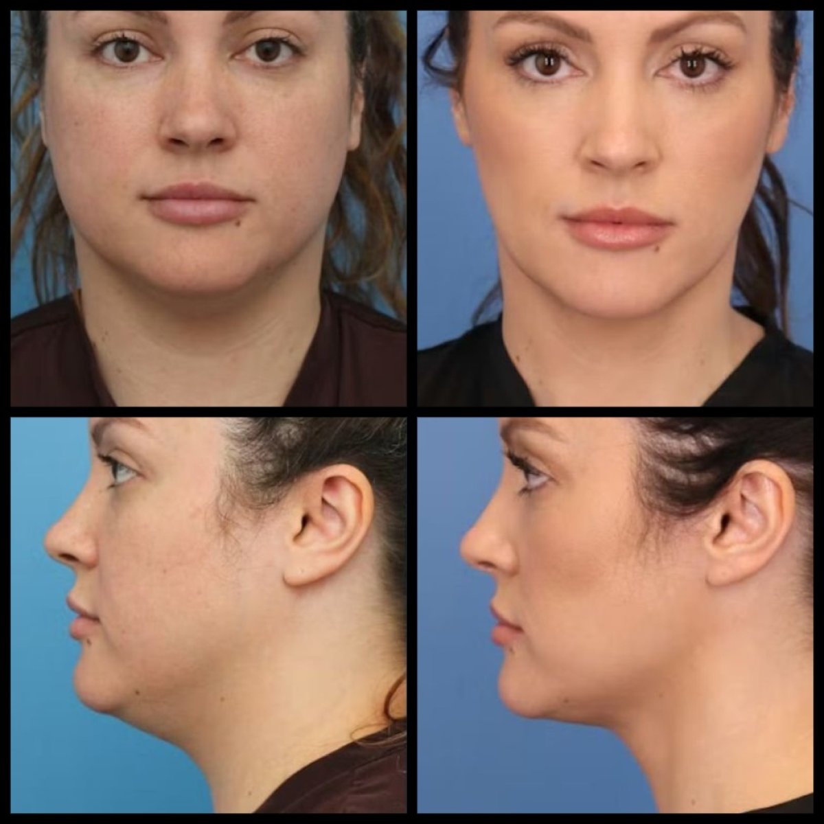 Résultats avant/après liposuccion du menton chez Dr. Alexandro Aguilera - Plastic Surgery