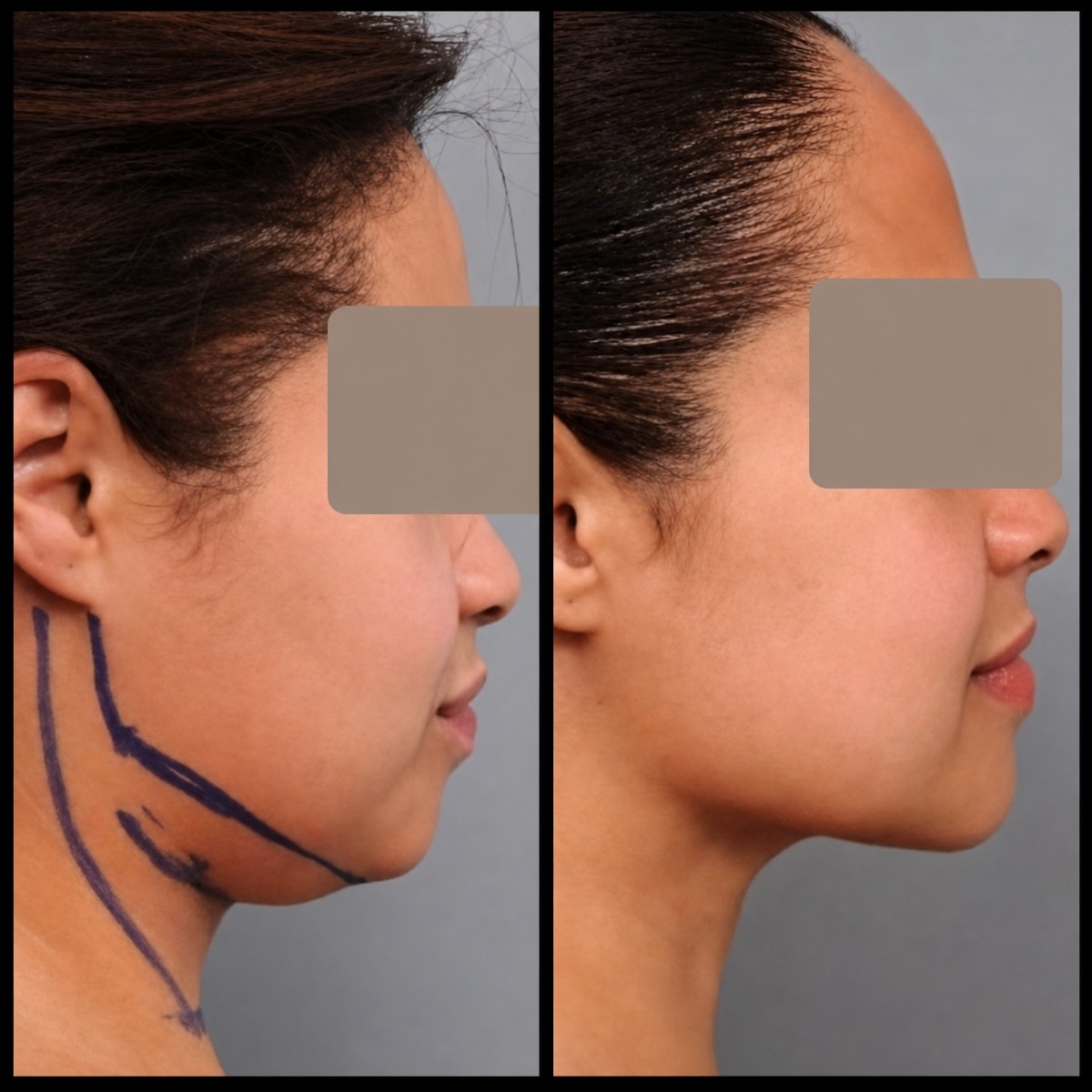 نتائج شفط دهون الذقن قبل وبعد في عيادة Dr. Alexandro Aguilera - Plastic Surgery