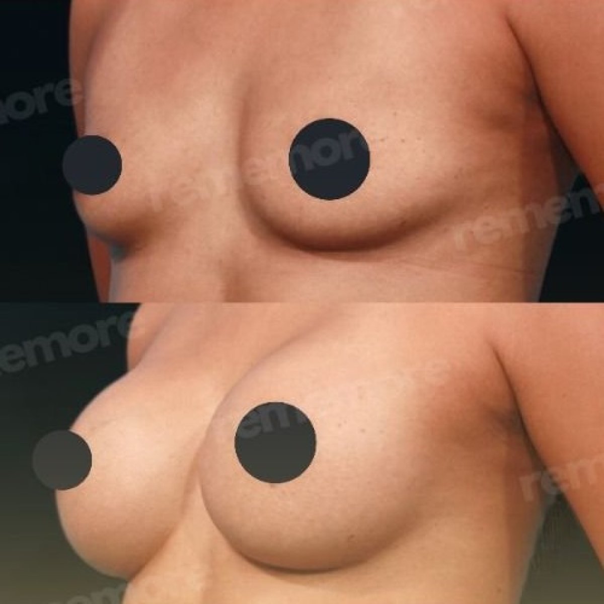 Résultats avant/après mammoplastie à Memorial Ataşehir Hospital, augmentation visible des seins