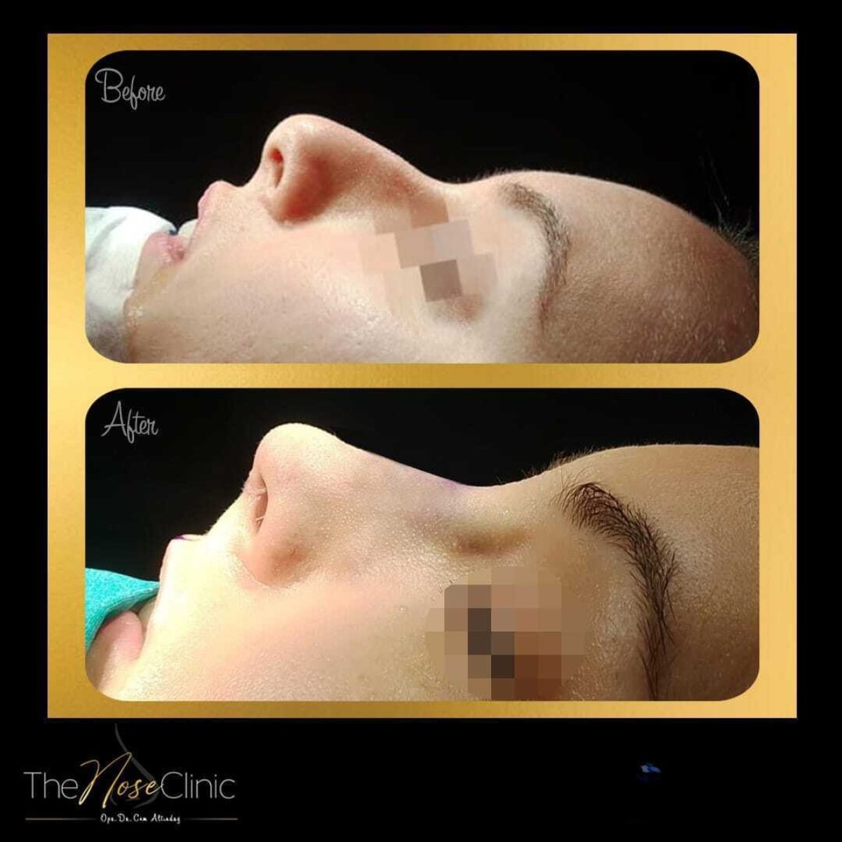 Resultados de rinoplastia antes y después en The Nose Clinic, perfil nasal mejorado