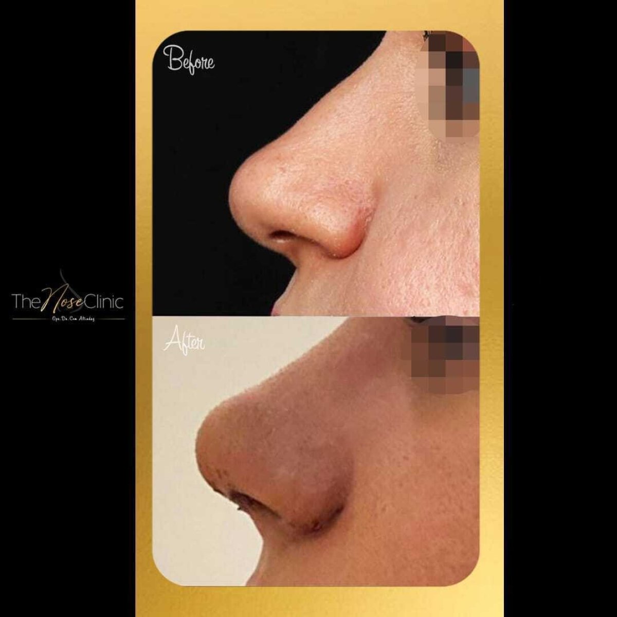 Resultados de rinoplastia antes y después en The Nose Clinic, remodelación nasal natural