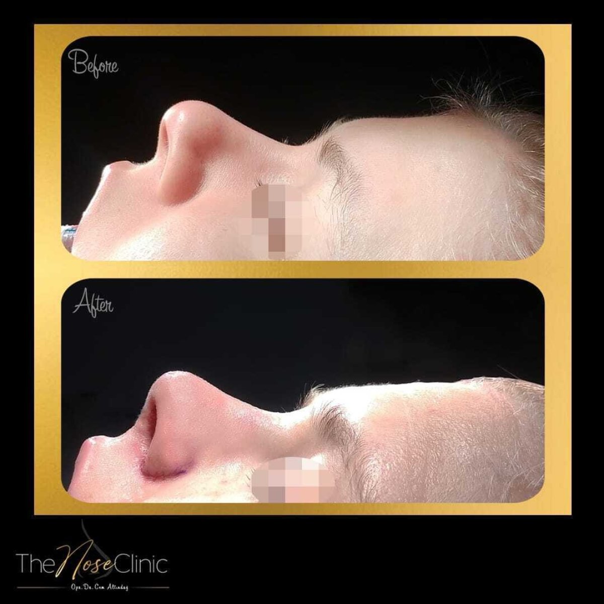 Resultados de rinoplastia antes y después en The Nose Clinic, perfil nasal natural