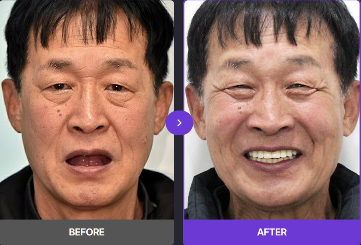 Before and after All-on-4 dental implants result at 365SeoulOneTop365 Dental Clinic, smile restored