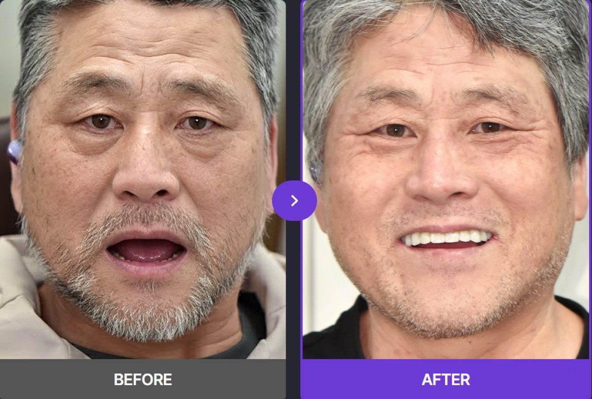 Before and after All-on-4 dental implants result at 365SeoulOneTop365 Dental Clinic, improved smile