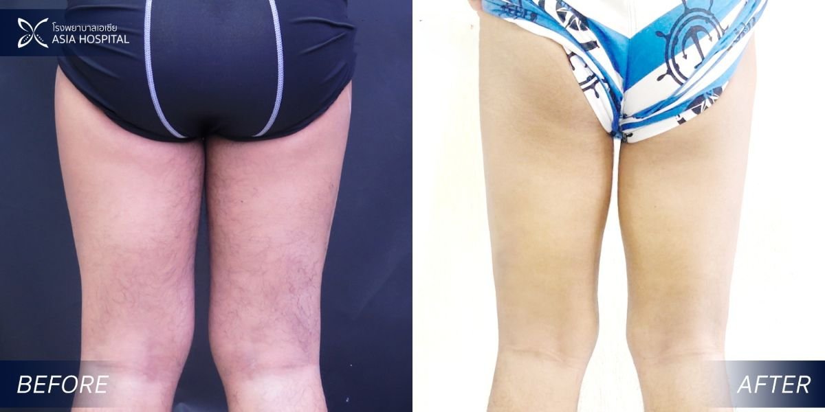 نتائج شد الفخذين قبل وبعد في Asia Cosmetic Hospital – تحسين شكل الفخذين