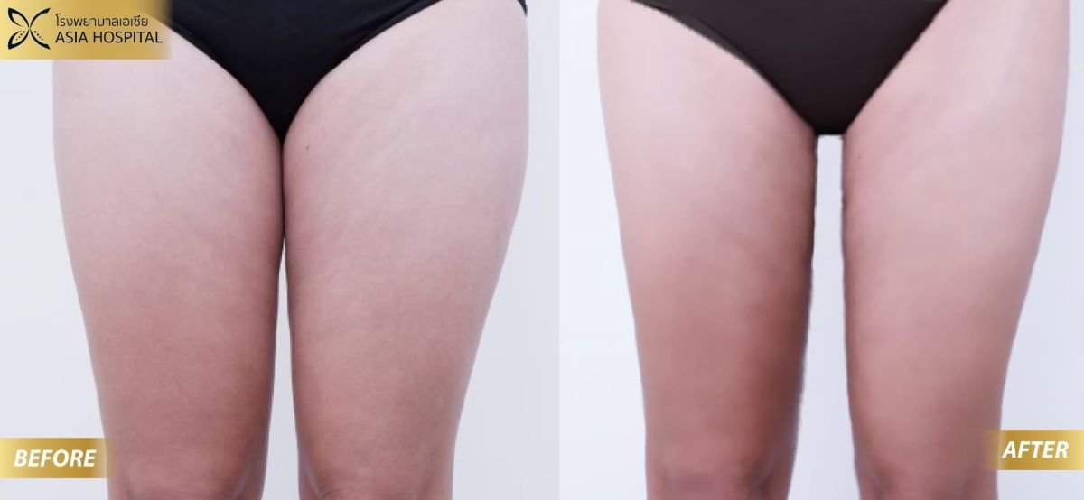 Before and after thigh lift results at Asia Cosmetic Hospital, improved thigh contour visible