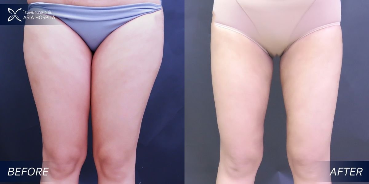 نتائج شد الفخذين قبل وبعد في Asia Cosmetic Hospital مع تحسين شكل الفخذين