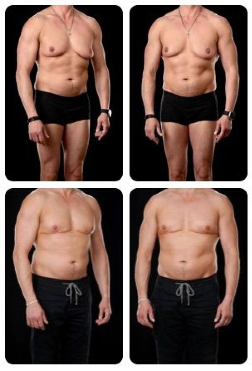 Результаты до и после операции гинекомастии в Yurchenko Plastic Surgery Team, контур груди