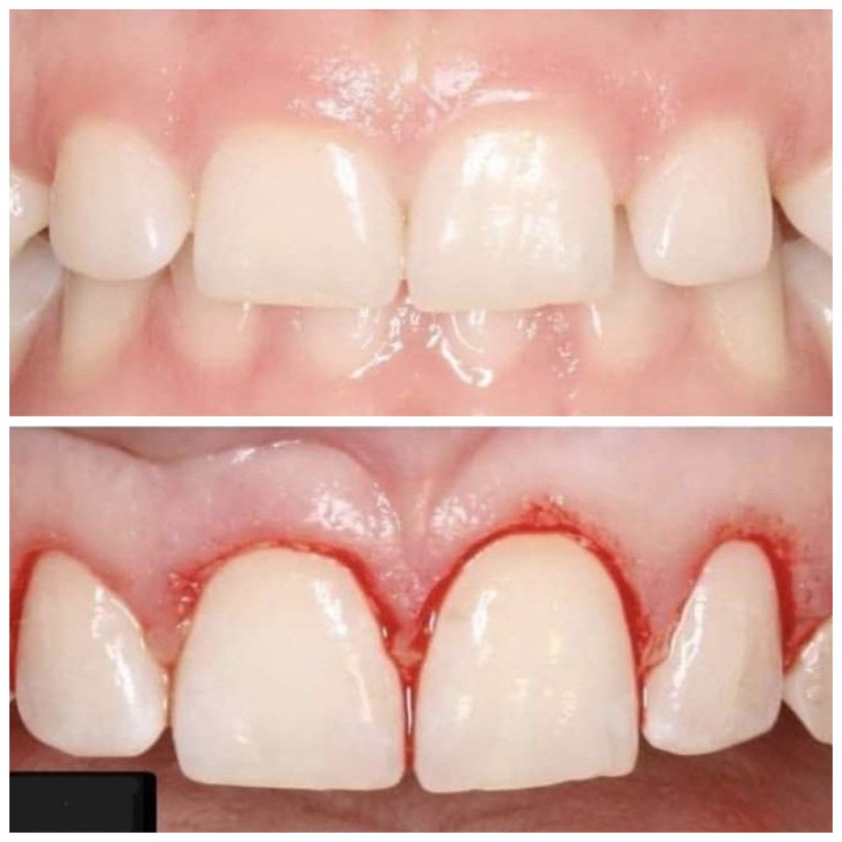 Before and after gum surgery results at SoftDentalCare Clinic, improved gum contour visible