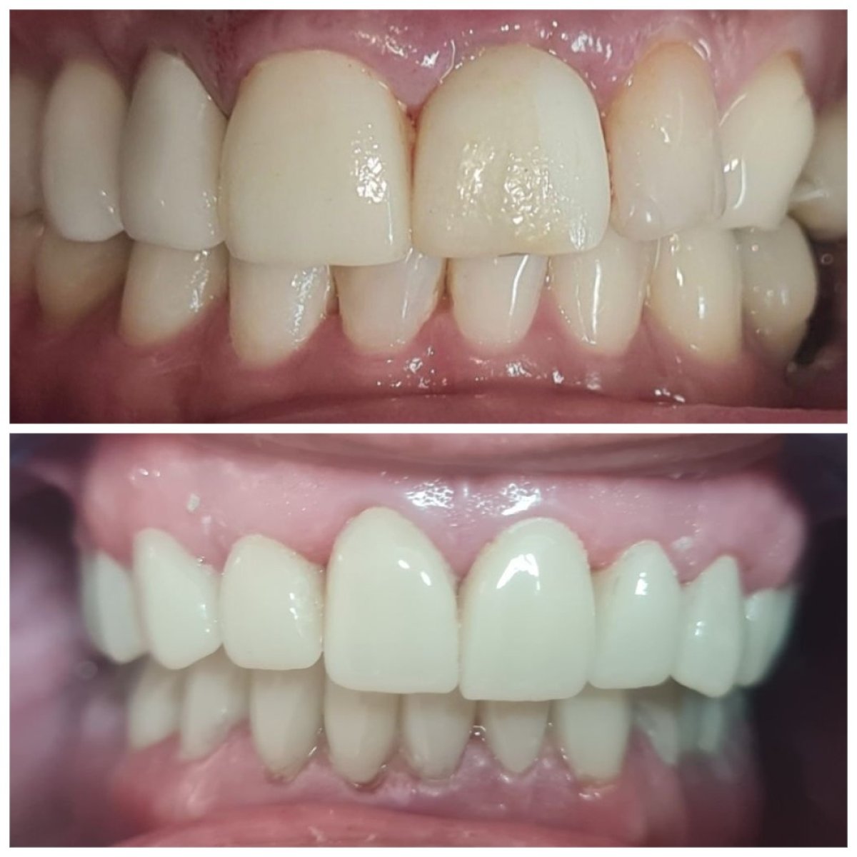 Результати до та після операції на яснах у SoftDentalCare Clinic, покращена лінія ясен