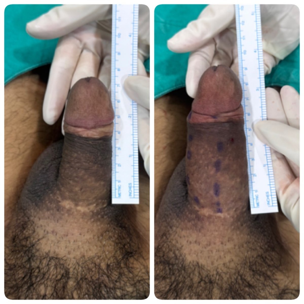 نتائج تكبير القضيب قبل وبعد في Eternity Clinic Pleonchit، زيادة واضحة بالطول