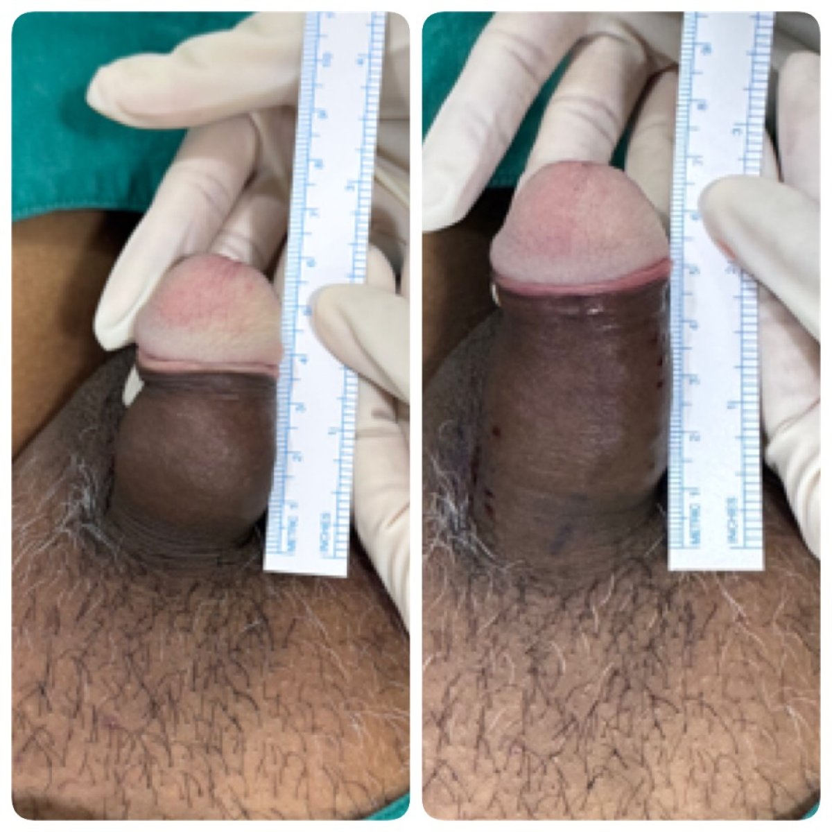 نتائج تكبير القضيب قبل وبعد في Eternity Clinic Pleonchit، زيادة واضحة في الطول