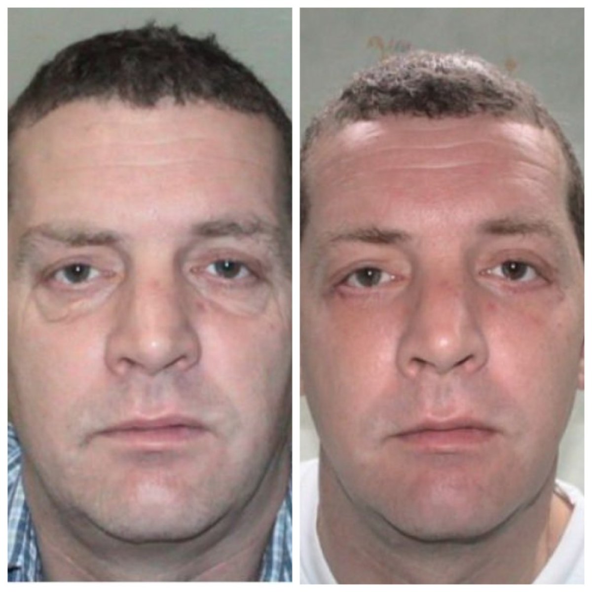 Resultados de lifting facial antes y después en Bangkok Plastic Surgery, rejuvenecimiento visible