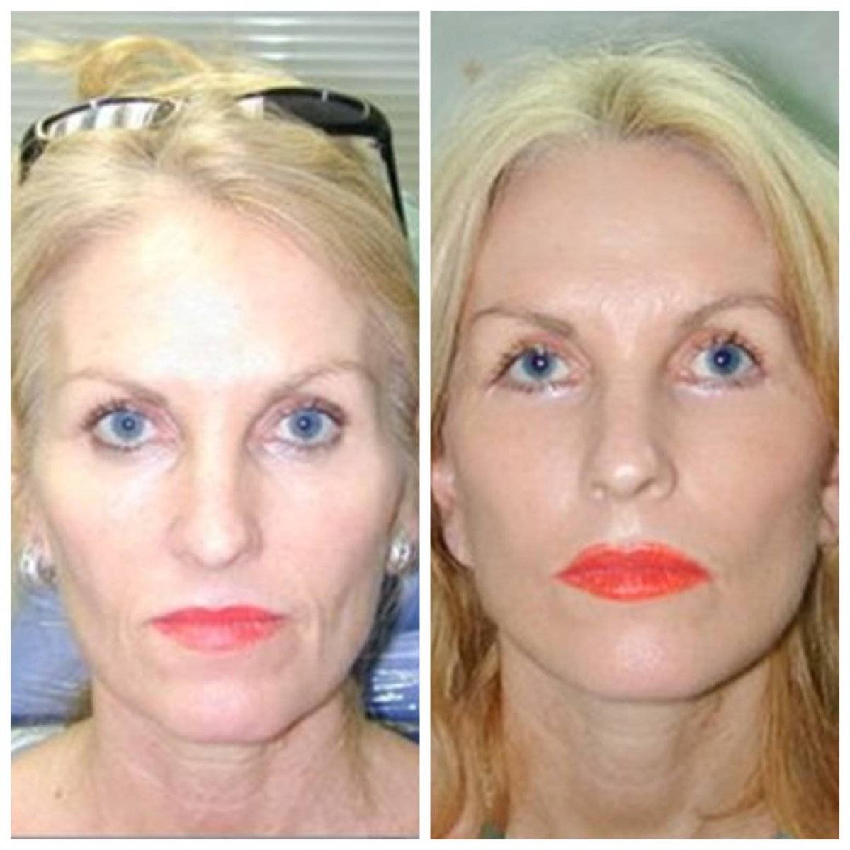 Resultados de lifting facial antes y después en Bangkok Plastic Surgery – rejuvenecimiento facial