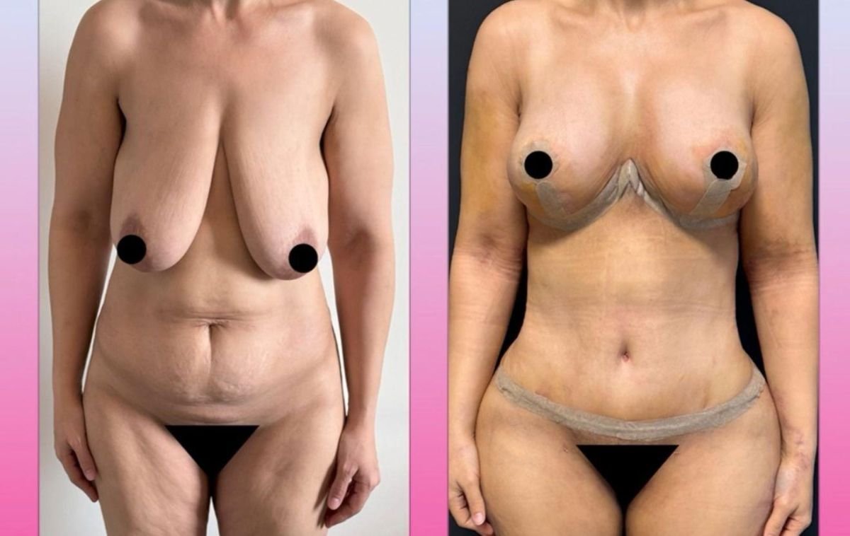 Before and after tummy tuck and breast lift results at Dr. Safa Manav Clinic, body contouring