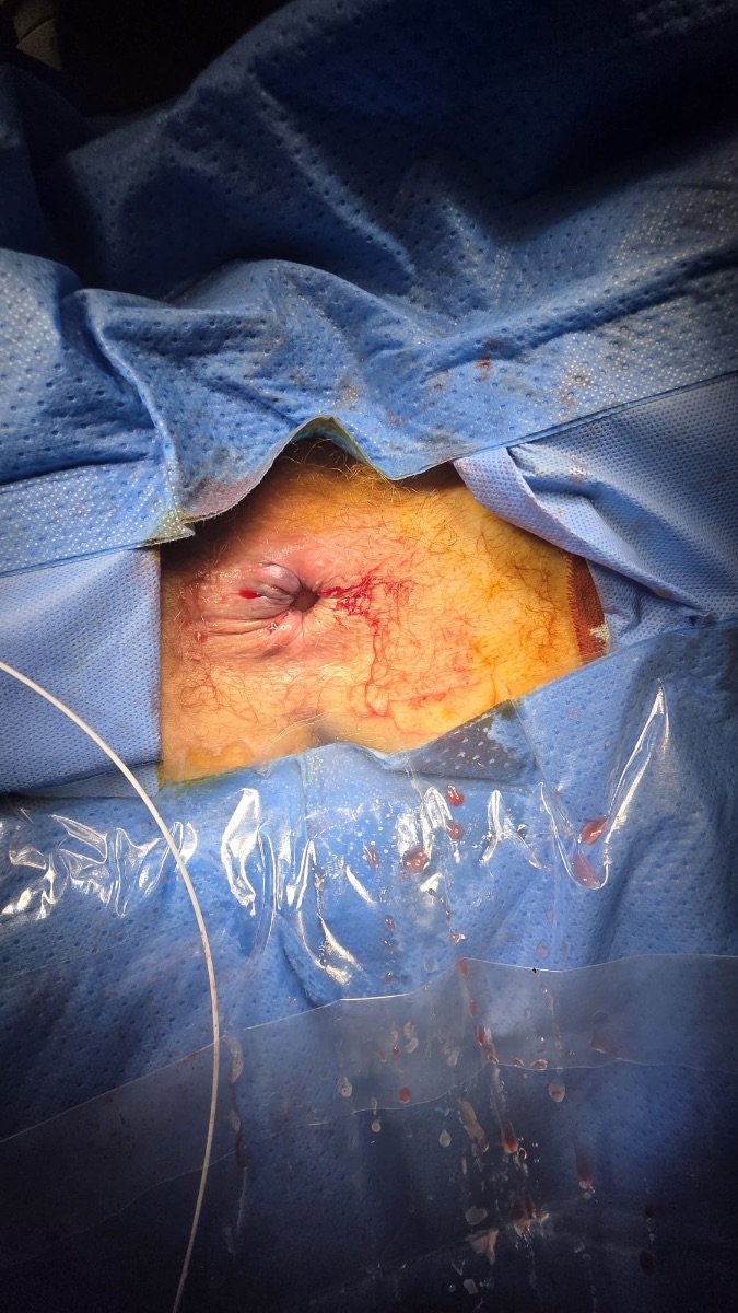Resultado tras terapia de hemorroides en Digestive Surgery and Gastroenterology Centro PAD