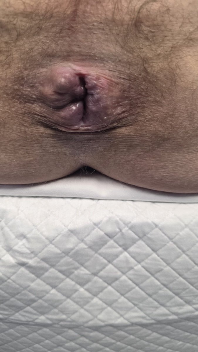 Resultado de terapia de hemorroides en Digestive Surgery and Gastroenterology Centro PAD