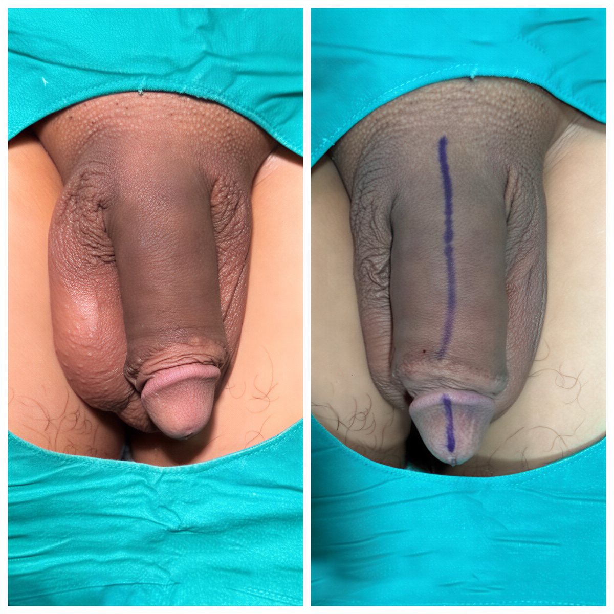 Resultados antes y después de relleno de pene en Eternity Clinic Pleonchit, mejora visible