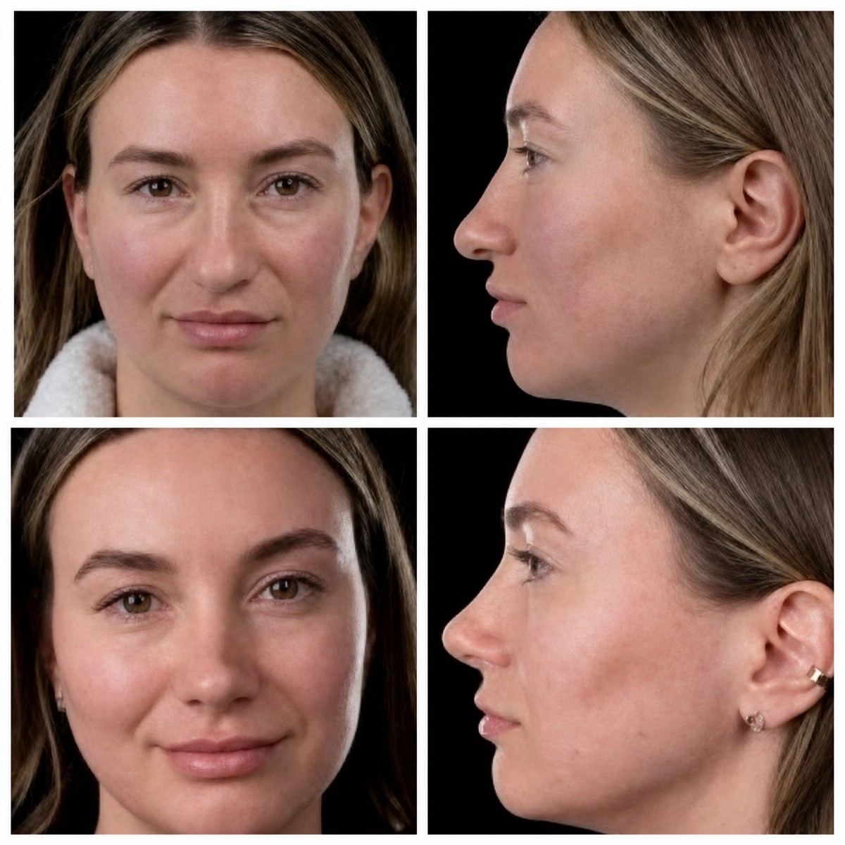Результаты ринопластики до и после в Yurchenko Plastic Surgery Team, коррекция носа