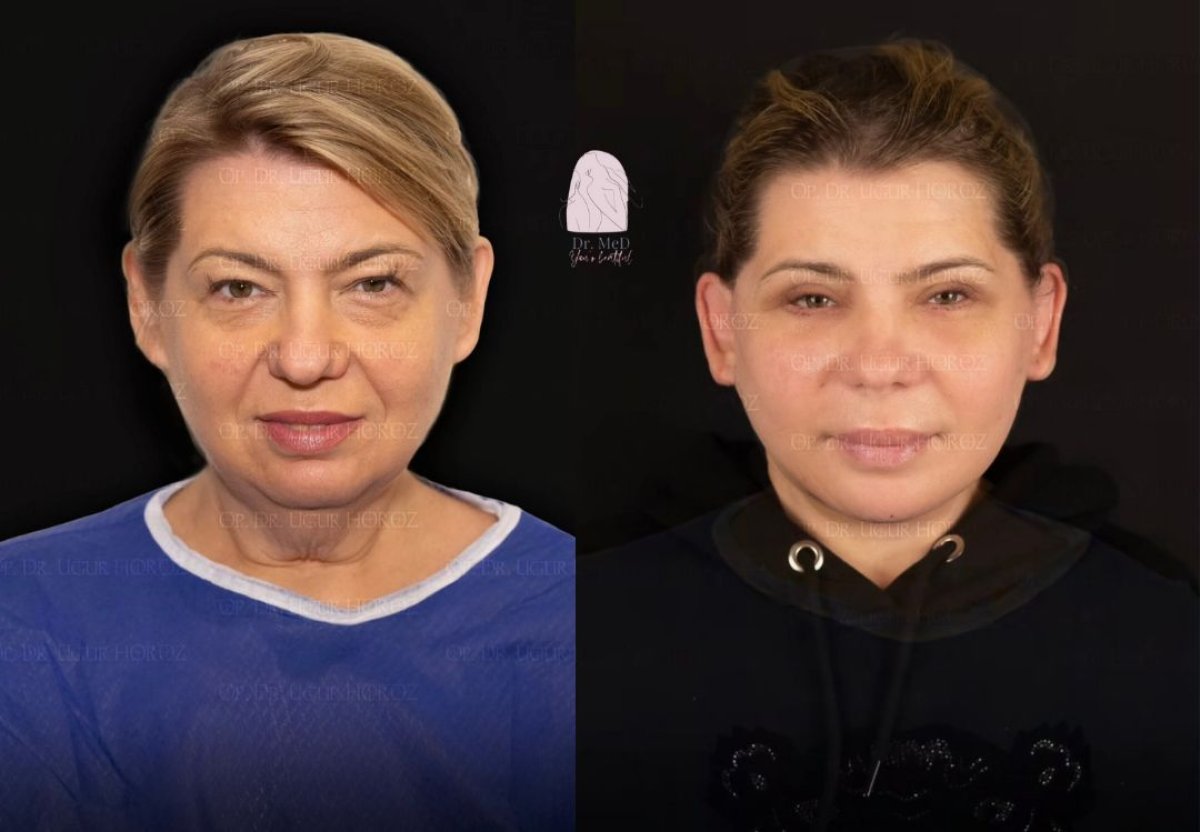 Resultados de minilifting facial antes y después en Dr. MED – rejuvenecimiento visible