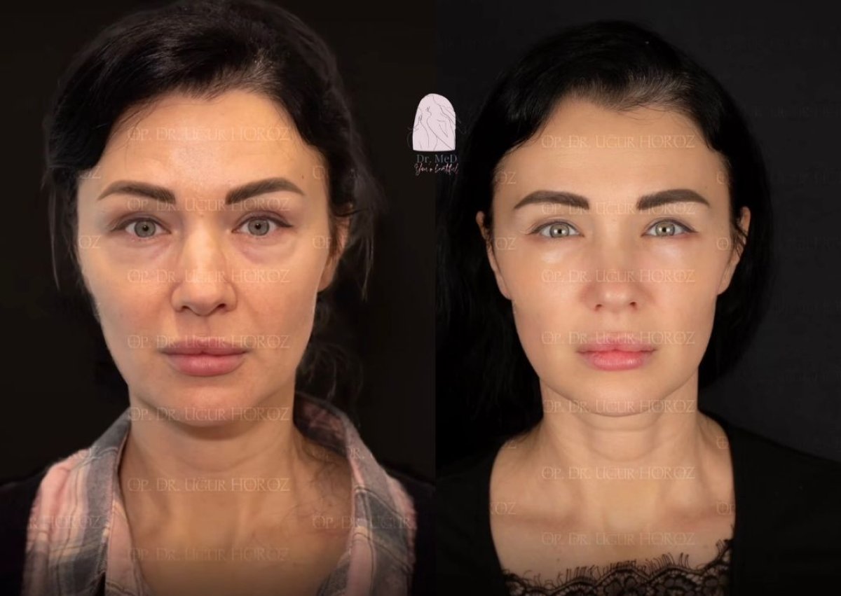 Before and after mini facelift results at Dr. MED – facial rejuvenation and smoother skin