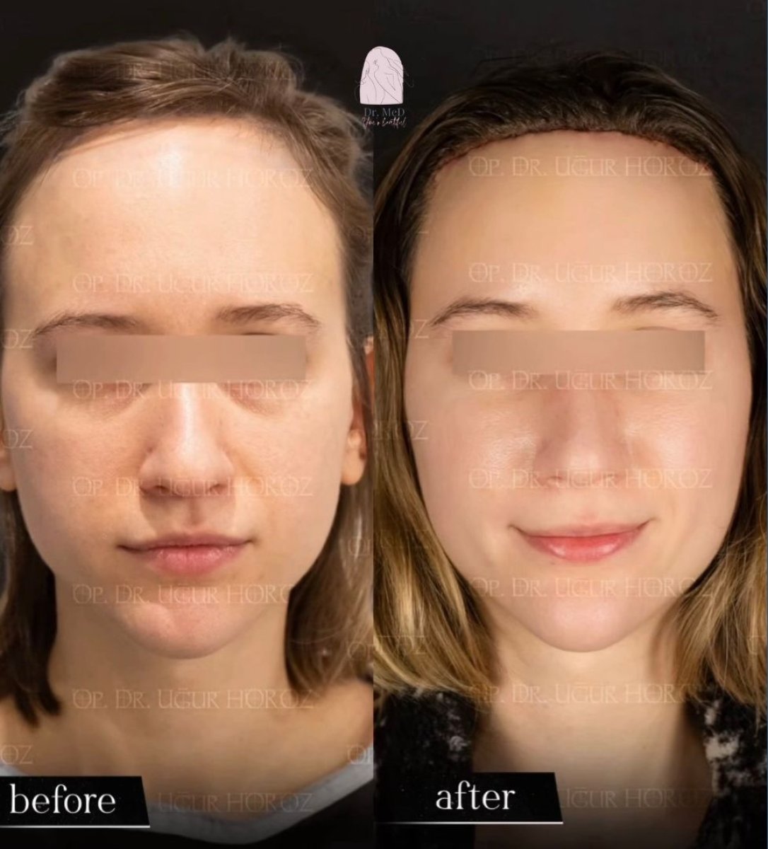 Resultados de minilifting facial antes y después en Dr. MED – rejuvenecimiento facial